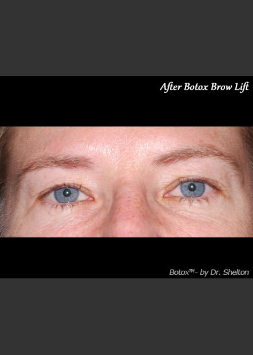 After Photo for Treatment of Perioral Wrinkles - Ron M. Shelton, M.D.  - ZALEA Featured Before & After