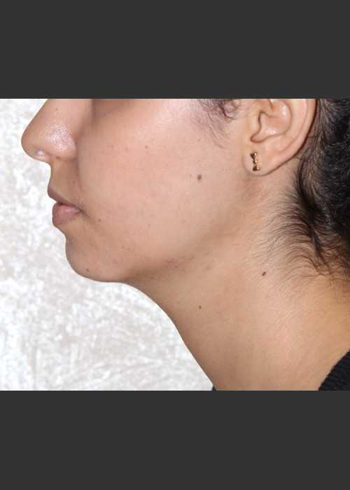 After Photo for Chin Augmentation - Bryan J. Correa, MD  - ZALEA Featured Before & After