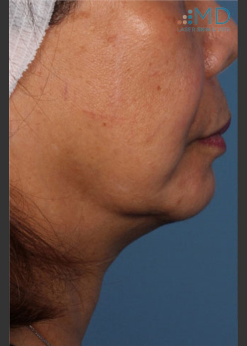 Before Photo for Ultherapy Skin Laxity Treatment - Robert Weiss, M.D., F.A.A.D., F.A.C.Ph - ZALEA Featured Before & After