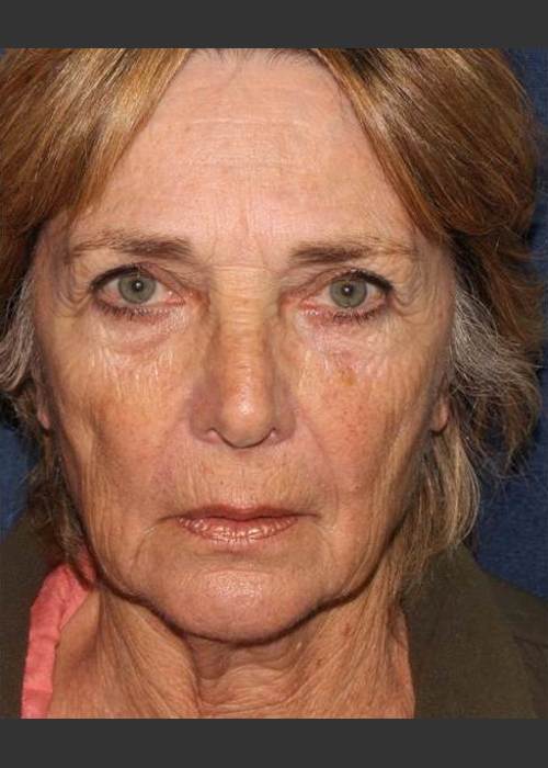 Before Photo for Facial Volumization - Kimberly J. Butterwick M.D. - ZALEA Featured Before & After