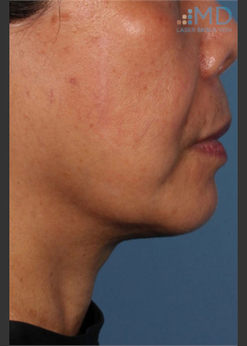 After Photo for Ultherapy Skin Laxity Treatment of Lower Face - Margaret Ann Weiss  - ZALEA Featured Before & After