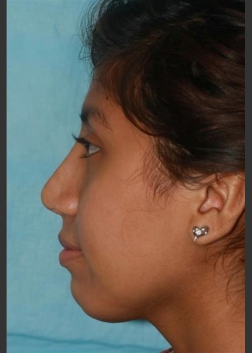 After Photo for Rhinoplasty - Case 13 - Konstantin Vasyukevich, MD  - ZALEA Featured Before & After