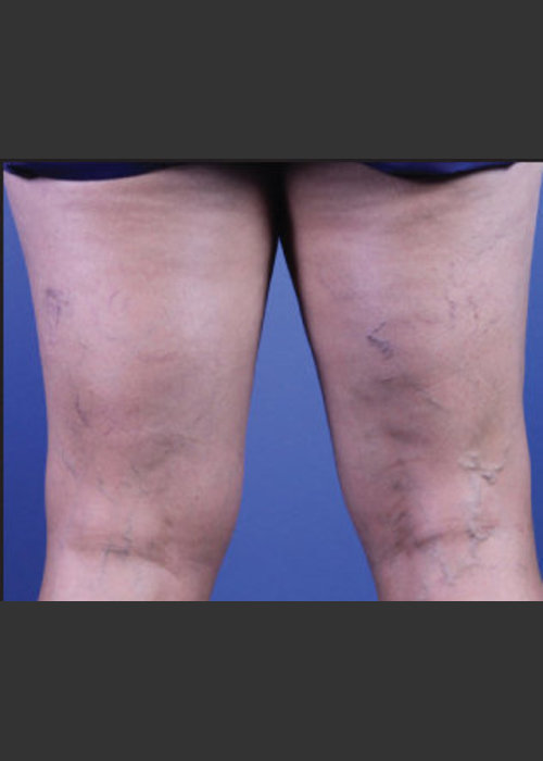 Before Photo for Sclerotherapy Treatment for Varicose Veins - Daniel Friedmann  - ZALEA Featured Before & After