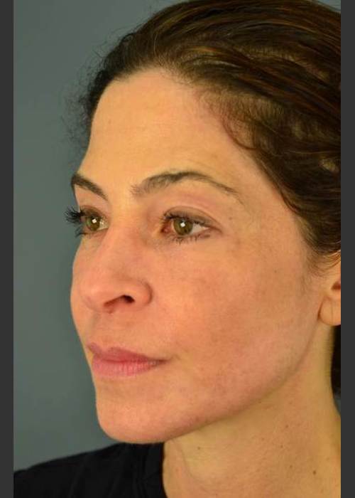 After Photo for C02 & Thermage Treatment #47 - Dr. David Amron  - ZALEA Featured Before & After