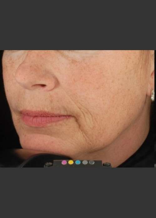Before Photo for Botox Dermal Fillers and Pigment Removal  - Brian D. Zelickson, M.D. - ZALEA Featured Before & After
