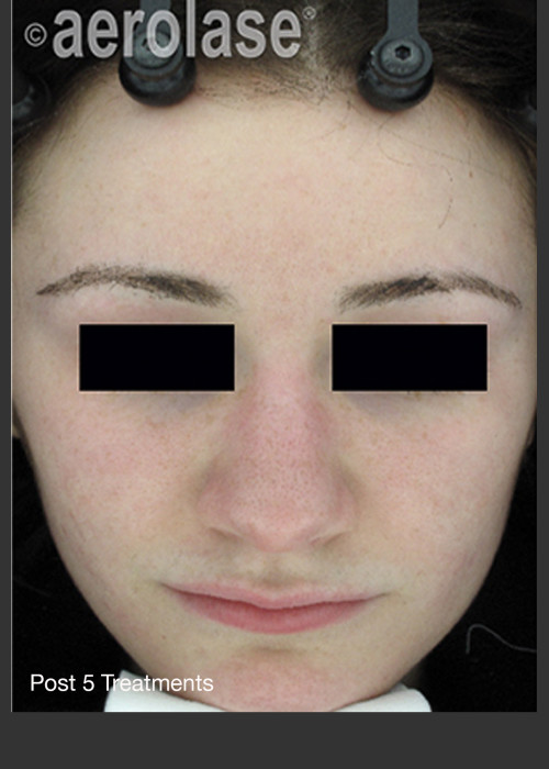 After Photo for NeoClear by Aerolase Acne Treatment - David J. Goldberg, M.D.  - ZALEA Featured Before & After