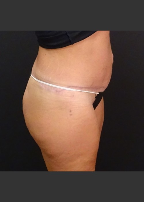 After Photo for Circumferential Body Lift Case #1 - Gallaher Plastic Surgery & Spa MD  - ZALEA Featured Before & After