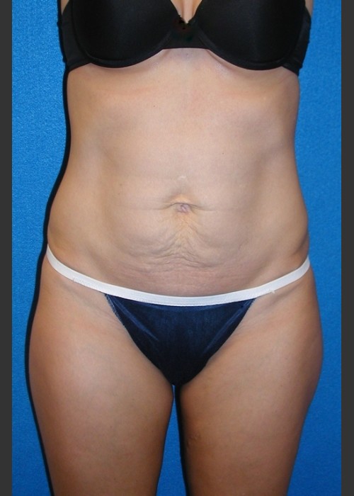 Before Photo for Tummy Tuck Case #2 - South Coast Plastic Surgery - ZALEA Featured Before & After