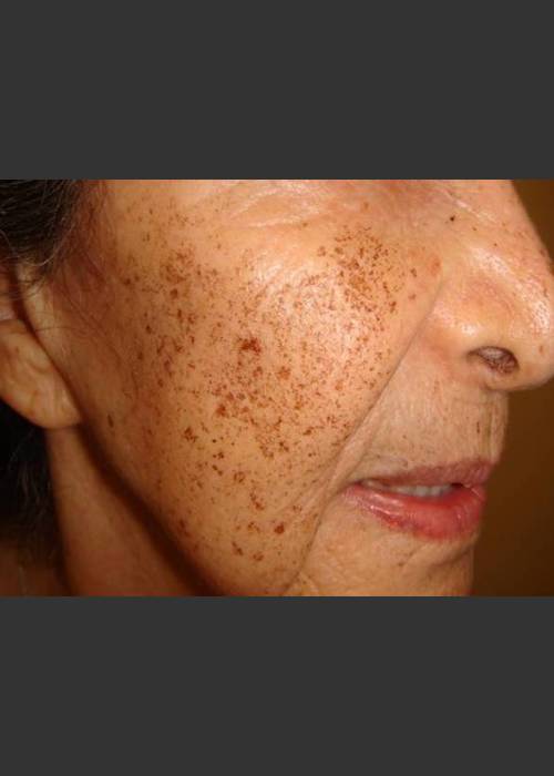 Before Photo for Rejuvenating devices sun damaged skin - Christopher B. Zachary, MD - ZALEA Featured Before & After