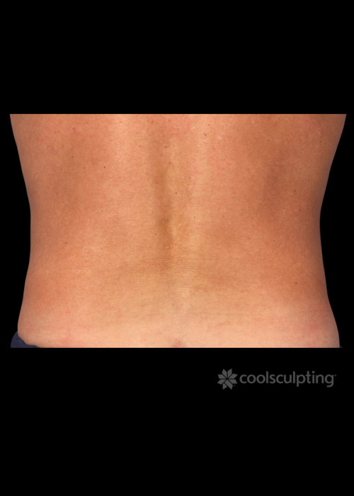 After Photo for CoolSculpting on Man Flanks (Love Handles) - W. Grant Stevens, MD, FACS  - ZALEA Featured Before & After