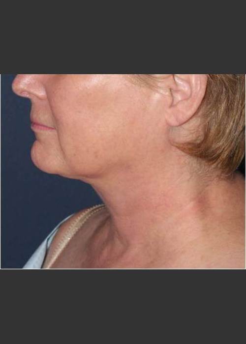 After Photo for Facial Liposculpture - William F. Groff, M.D.  - ZALEA Featured Before & After