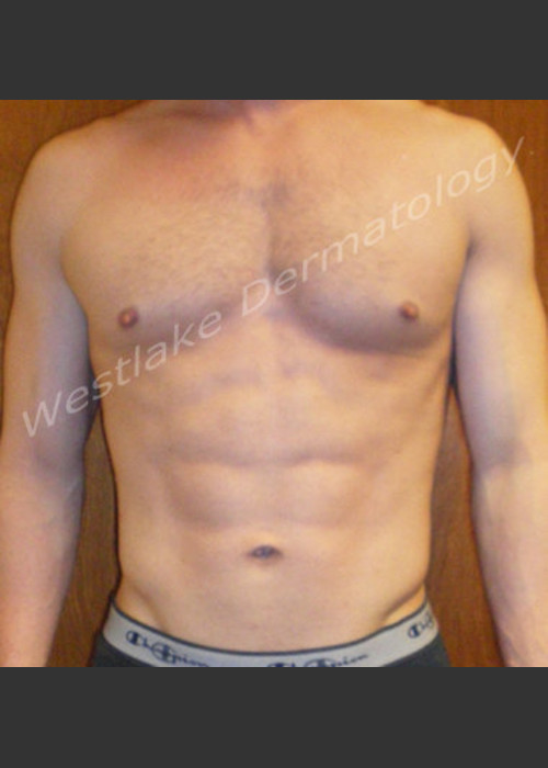 After Photo for SmartLipo Liposuction of Male Abdomen - Gregory A Nikolaidis  - ZALEA Featured Before & After
