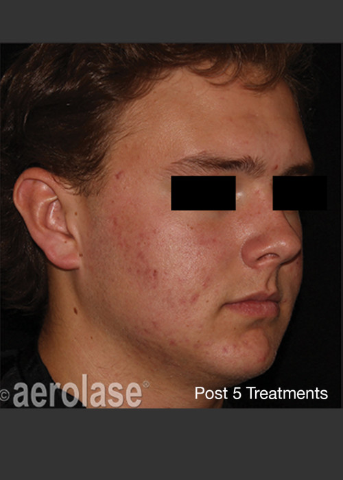 After Photo for NeoClear by Aerolase Acne Treatment - Amy Forman Taub, MD  - ZALEA Featured Before & After