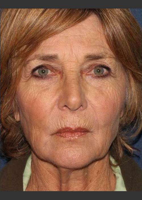 After Photo for Facial Volumization - Kimberly J. Butterwick M.D.  - ZALEA Featured Before & After
