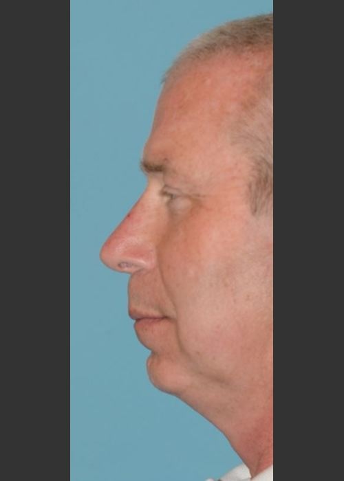 After Photo for Rhinoplasty Male Patient - Timothy Miller  - ZALEA Featured Before & After