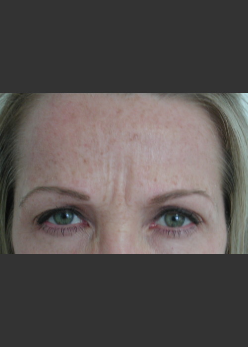 Before Photo for Serene Procedure (Nuebelle) - James Newman - ZALEA Featured Before & After