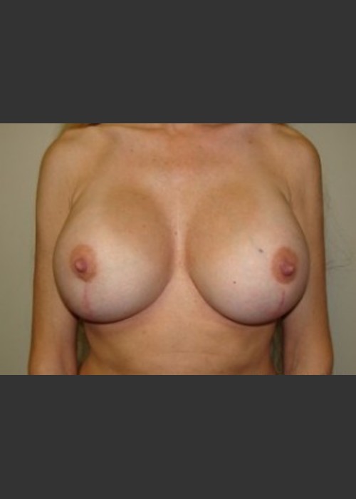 After Photo for Breast Revision 5654 - Sanjay Grover MD FACS  - ZALEA Featured Before & After