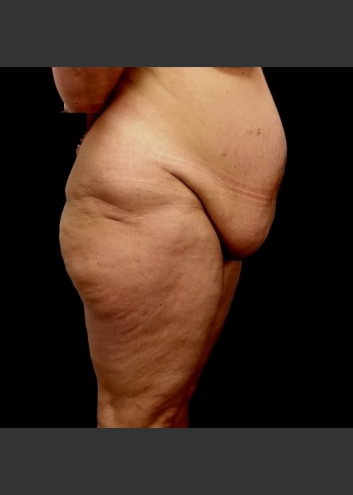 Before Photo for Circumferential Body Lift Case #1 - Gallaher Plastic Surgery & Spa MD - ZALEA Featured Before & After