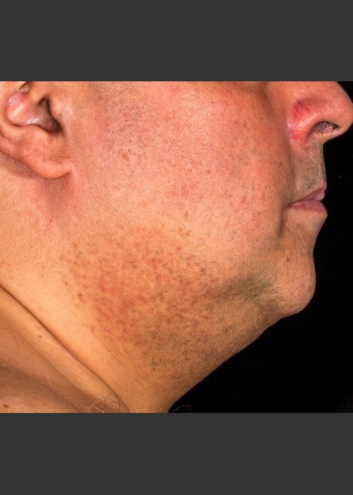 After Photo for SculpSure Submental - Lawrence Bass MD  - ZALEA Featured Before & After
