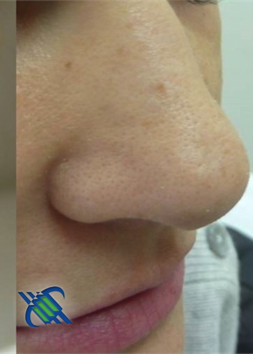 After Photo for Treatment of Nose Acne Scar - Roy G. Geronemus, M.D.  - ZALEA Featured Before & After