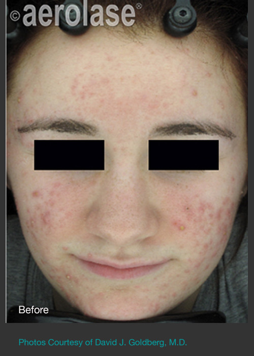 Before Photo for NeoClear by Aerolase Acne Treatment - David J. Goldberg, M.D. - ZALEA Featured Before & After