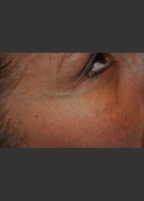Before Photo for Dr. Palmer Vein Removal 01 - Shane Palmer - ZALEA Featured Before & After