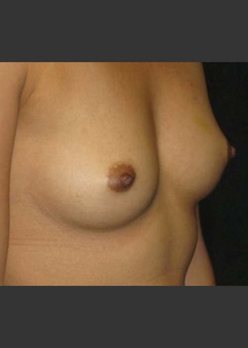 Before Photo for Breast Augmentation - Robert Aycock - ZALEA Featured Before & After