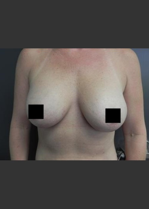 After Photo for Breast Augmentation - Brian P. Tierney, MD  - ZALEA Featured Before & After