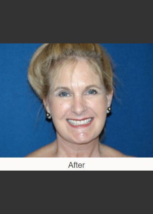 After Photo for Facelift - Case #23 Details - James N. Romanelli, MD, FACS  - ZALEA Featured Before & After