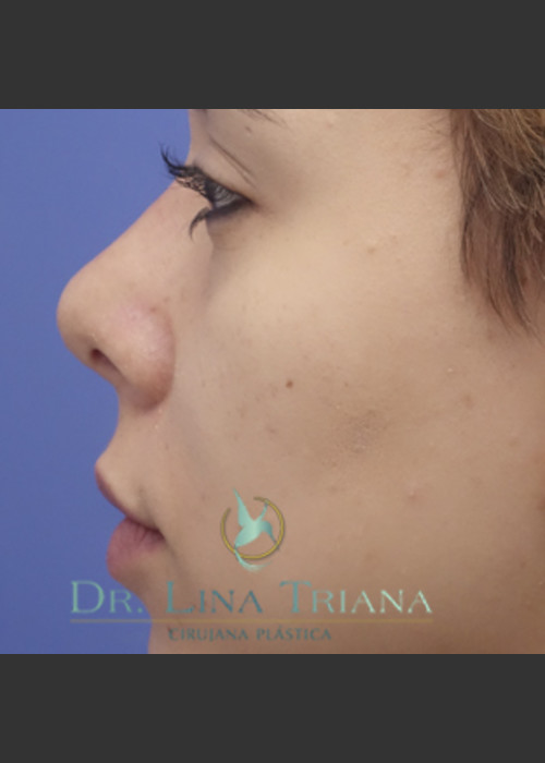 After Photo for Rhinoplasty Female Patient - Lina Triana, MD  - ZALEA Featured Before & After
