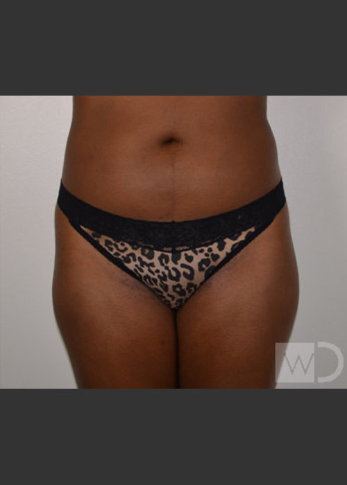 Before Photo for SmartLipo Liposuction of Outer Thighs - Chuma Chike-Obi MD - ZALEA Featured Before & After