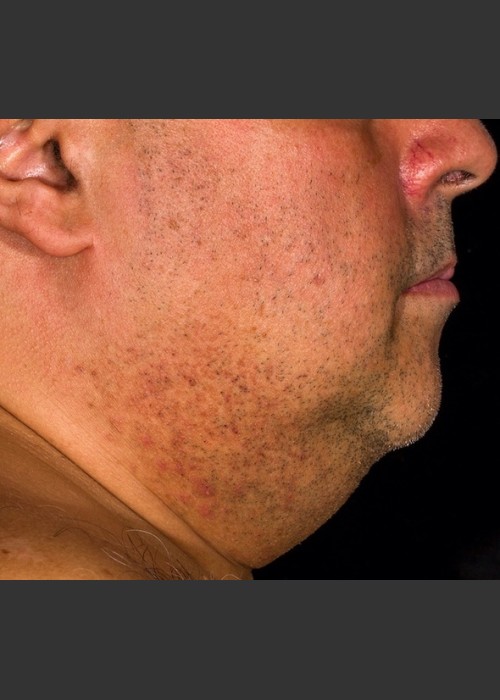Before Photo for SculpSure Submental - Lawrence Bass MD - ZALEA Featured Before & After