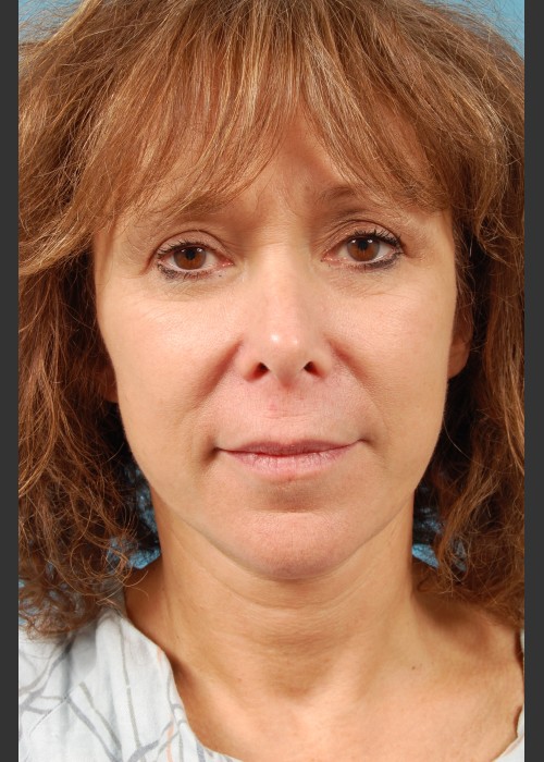 After Photo for Facelift Surgery - Thomas A. Mustoe, MD, FACS  - ZALEA Featured Before & After