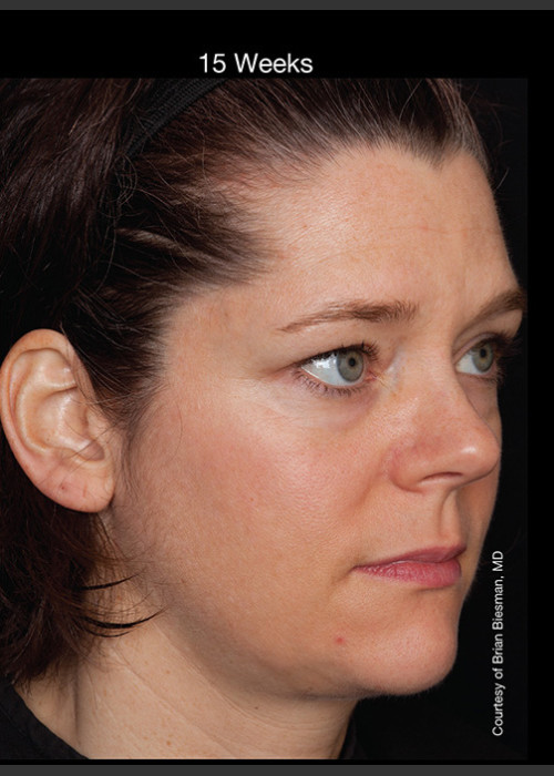 After Photo for Hyperpigmentation - Professional Peel - Brian S. Biesman, MD  - ZALEA Featured Before & After