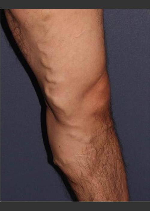 Before Photo for Non-surgical Leg Vein Treatment - Mitchel P. Goldman M.D. - ZALEA Featured Before & After