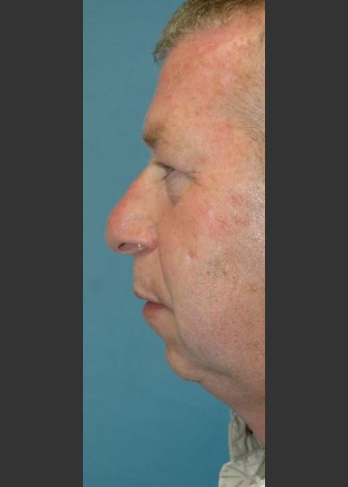 Before Photo for Rhinoplasty Male Patient - Timothy Miller - ZALEA Featured Before & After