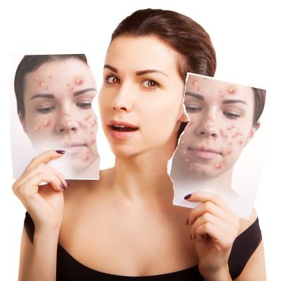 Finally, A Laser that Tackles Age and Acne 