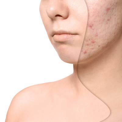 The Best Treatment for Acne Scars and Facial Aging