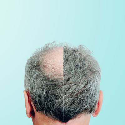 Is Your <b>Hair</b> Thinning?