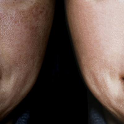Say Goodbye to Brown Spots!