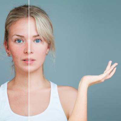 What Can I Do For Congested Pores and Blackheads?