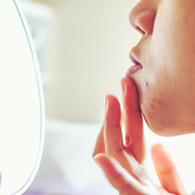 What's The Deal With Adult Acne?
