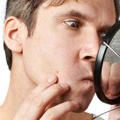 Ins and Outs of Male Acne