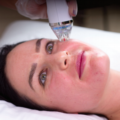 Intensif Review: Micro Needling & Acne Treatment