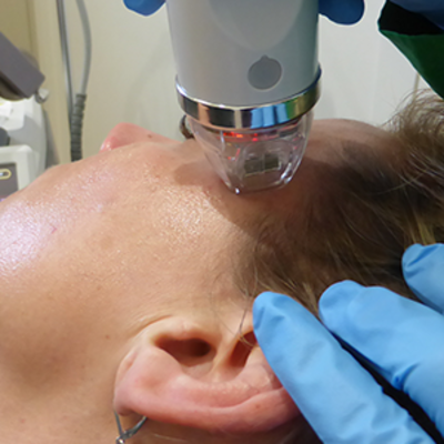 RF Microneedling Procedure: What is Radiofrequency Microneedling?