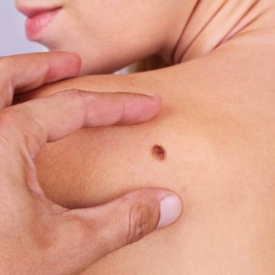 A Helpful Guide to Scan for Early Signs of Skin Cancer