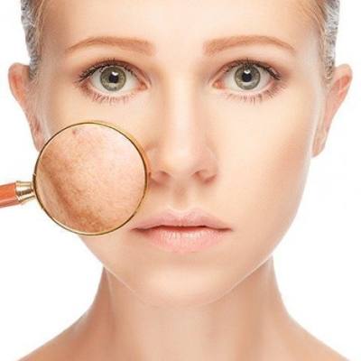 Summer Basics for Melasma