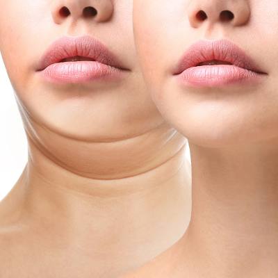Treat That Double Chin: CoolSculpting - Kybella - <b>SculpSure</b>