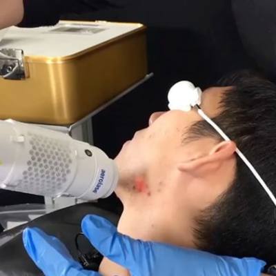NeoClear by Aerolase Procedure Review