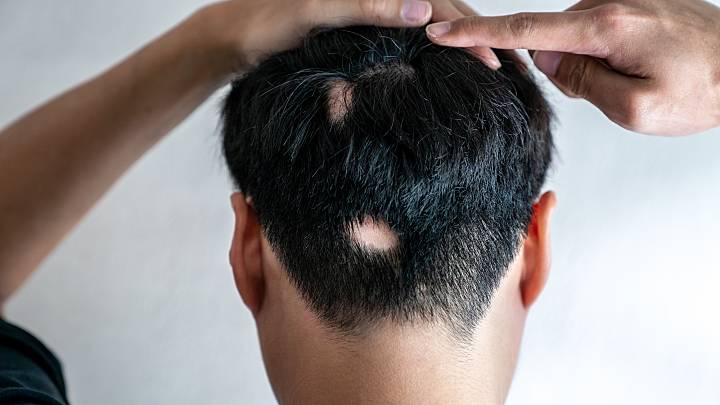 Alopecia areata (Kreisrunder Haarausfall) am Hinterkopf eines Mannes